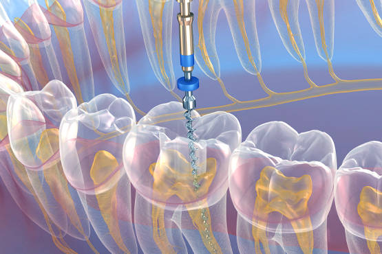 Leczenie kanałowe pod mikroskopem - endodoncja Puławy
