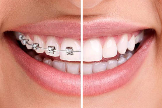 Ortodoncja - Aparaty na zęby Puławy